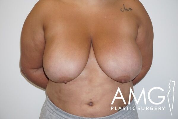 A person with large, natural breasts stands against a plain background, wearing gray pants. Their arms are behind their back. The image features the AMG Plastic Surgery logo in the bottom right corner.