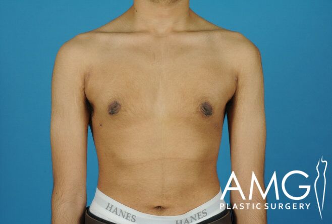A person with a bare chest stands against a blue background. The image features a visible logo for "AMG Plastic Surgery" in the lower right corner.