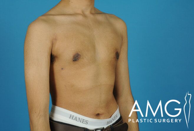 A person with a bare torso stands against a blue background, wearing Hanes underwear. AMG Plastic Surgery logo is displayed in the bottom right corner.