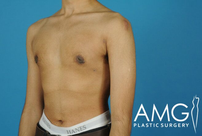A shirtless person against a blue background with "AMG Plastic Surgery" logo in the corner.