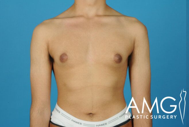A person with an uneven chest posing against a blue background. White waistband of briefs visible. AMG Plastic Surgery logo in the corner.