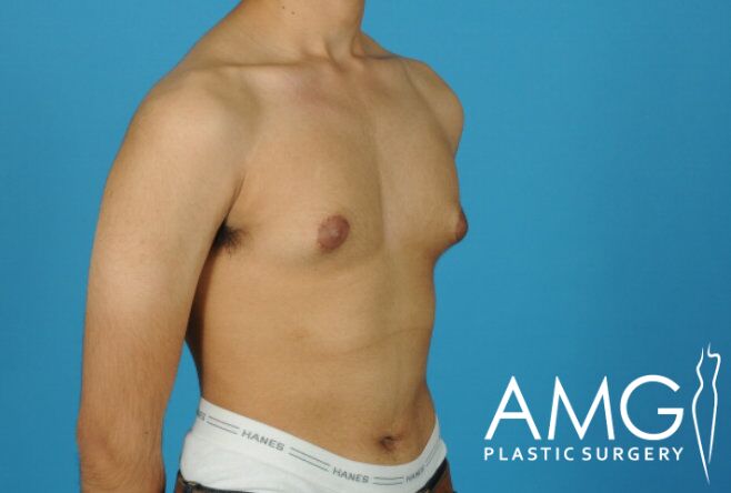 A shirtless person with gynecomastia on a blue background; AMG Plastic Surgery logo in the corner.