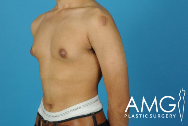 A person with a bare torso showing post-surgery marks on the chest, wearing jeans and visible waistband, against a blue background.