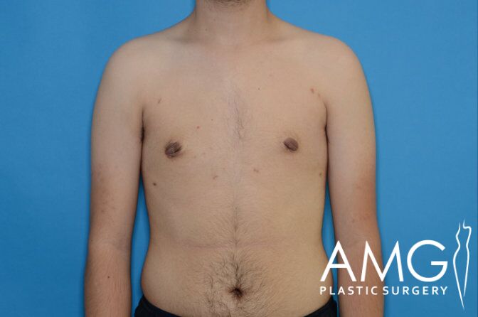 A shirtless person with a logo in the bottom right corner that reads "AMG Plastic Surgery." The background is blue.