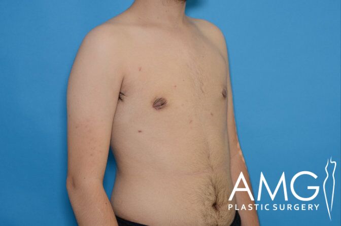 Person with bare torso facing left against a blue background, showing surgical scars. Logo reads "AMG Plastic Surgery" in the bottom right corner.