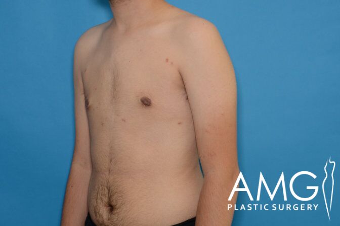 A shirtless person standing against a blue background, shown from the shoulders to waist. "AMG Plastic Surgery" logo in the bottom right corner.
