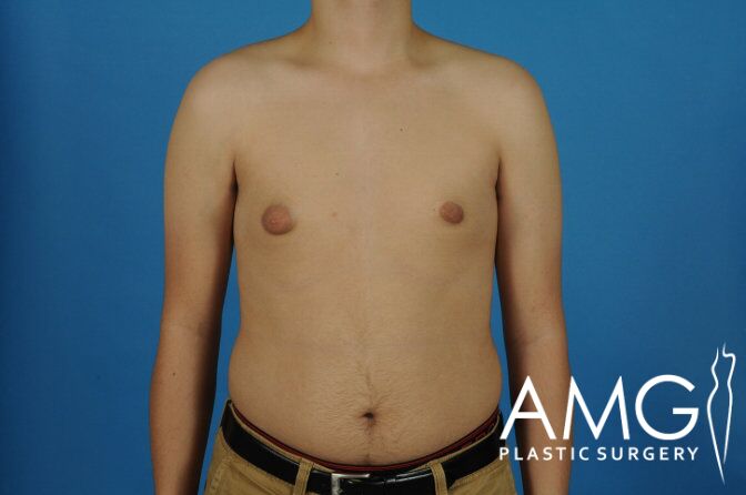 A person with bare chest stands against a blue background. The logo "AMG Plastic Surgery" is visible in the lower right corner.