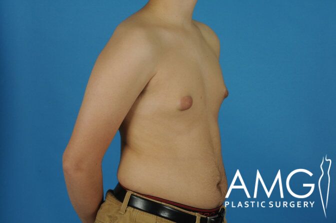 Side profile of a shirtless person with visible chest and abdomen against a blue background. "AMG Plastic Surgery" logo is in the bottom right corner.