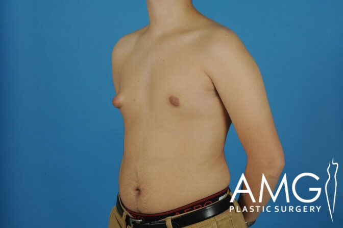 Person with gynecomastia stands in profile against a blue background. Plastic surgery logo is visible in the lower right corner.