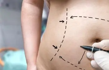 A person’s bare abdomen with black marker lines and arrows drawn on the skin, as a gloved hand marks areas, suggesting preparation for a cosmetic or surgical procedure, such as liposuction or a tummy tuck.