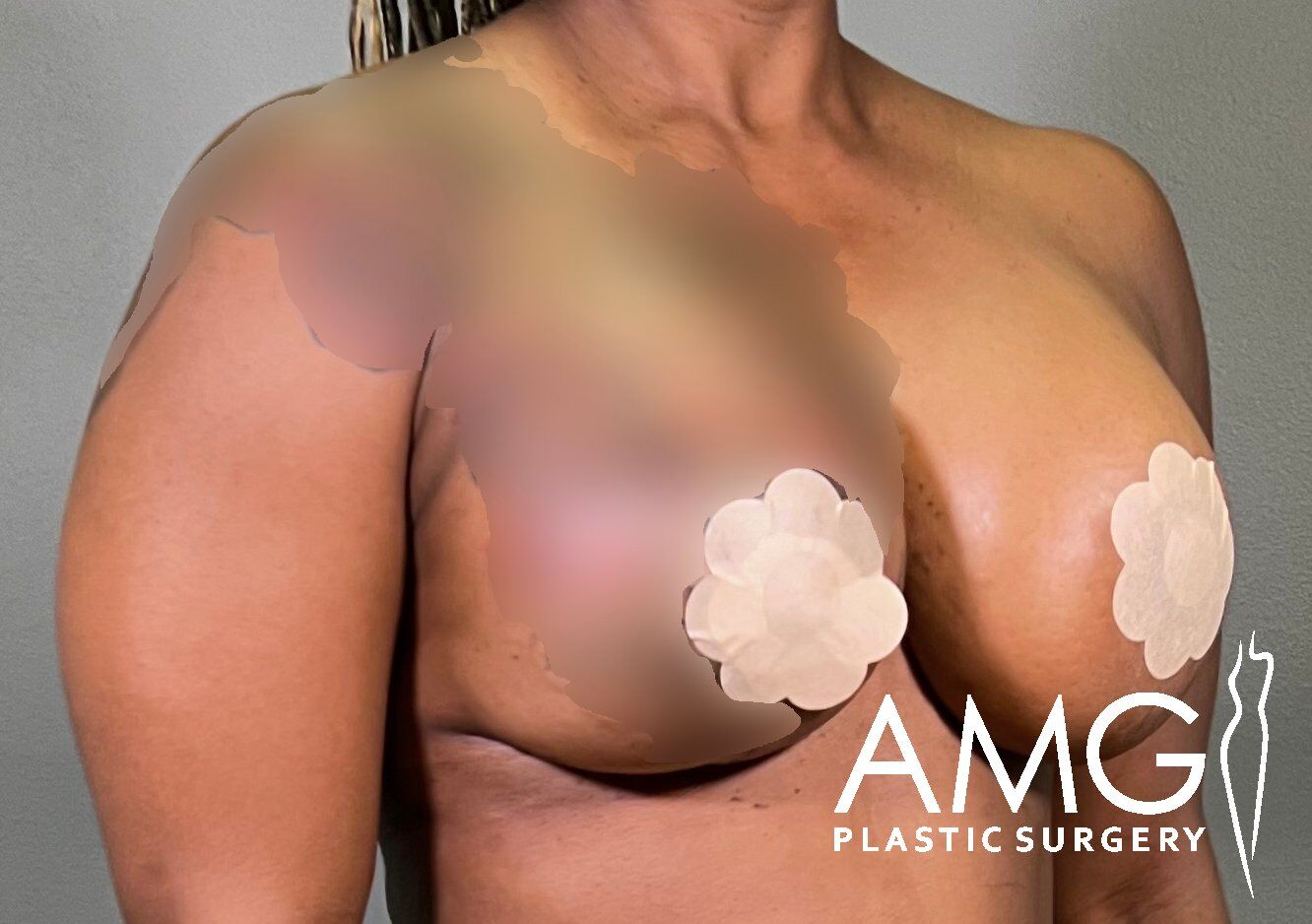 Person posing for a post-surgery photo with noticeable changes to the chest area. The image includes a logo for AMG Plastic Surgery.