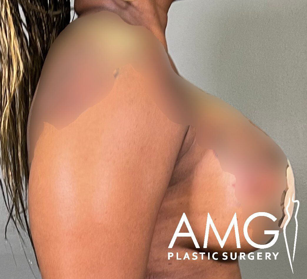 A person's upper back and shoulder against a neutral background, with wet hair partly visible. Logo of AMG Plastic Surgery is in the lower right corner.