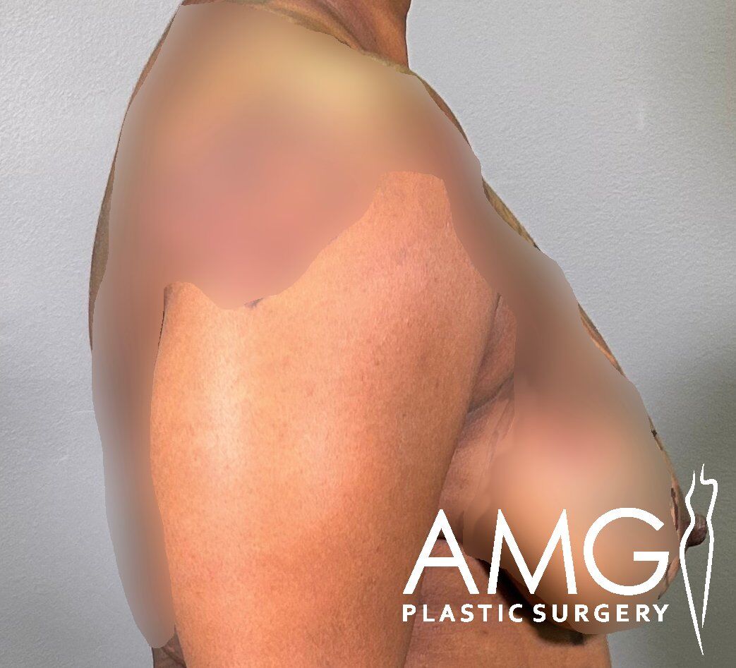 Side view of a person's upper body with blurred areas, displaying the logo "AMG Plastic Surgery" in the lower right corner.