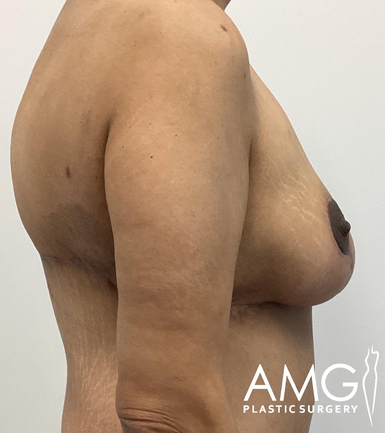 Side view of an adult's upper body showing the side of the torso and arm against a plain background with the AMG Plastic Surgery logo in the bottom right corner.