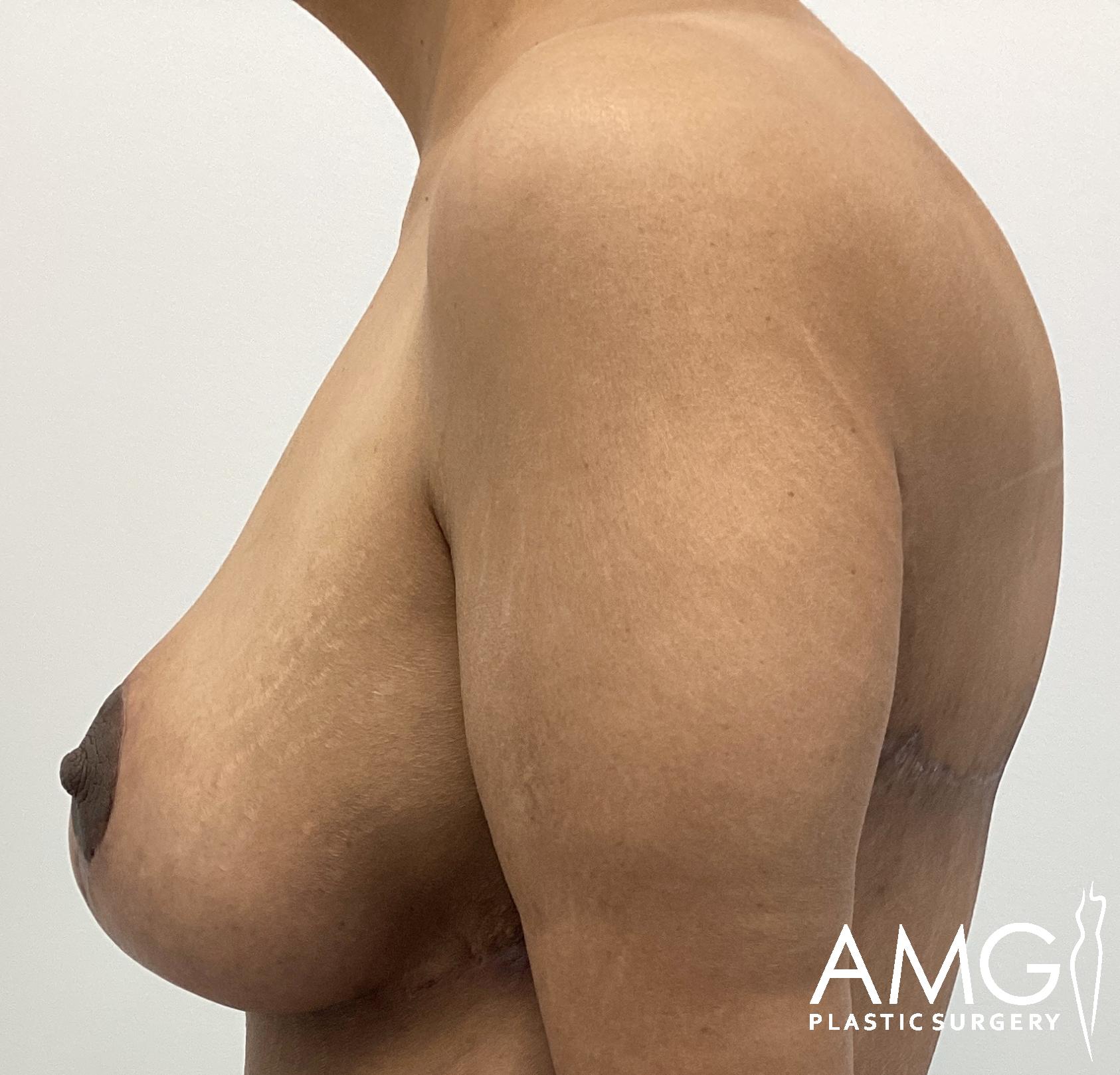 Side view of a person showing post-surgery scars on the torso near the chest. The image includes a partial view of one arm. Logo in the bottom right corner reads "AMG Plastic Surgery.