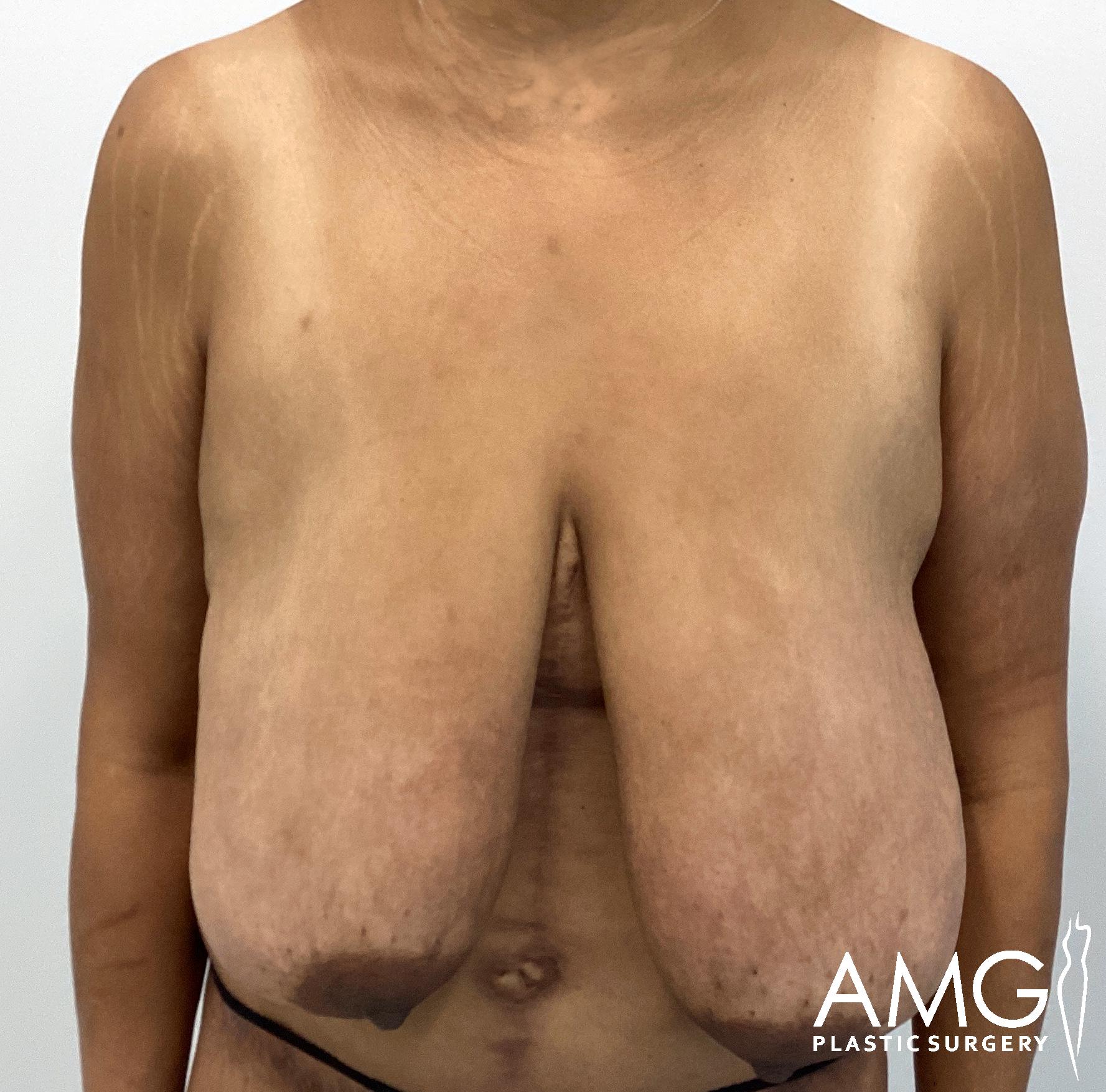 Close-up of a person with significant breast sagging and visible stretch marks standing against a plain background. The image has a watermark labeled "AMG Plastic Surgery.