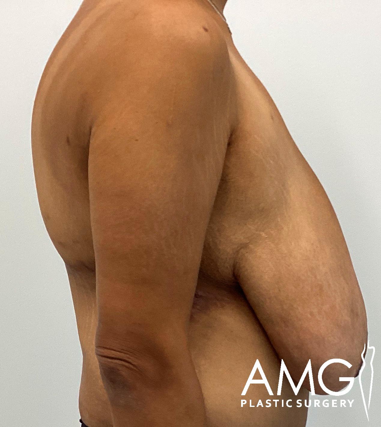 A person's torso is shown from the side, with the arm dropped along the body and the abdomen visible. Logo text "AMG Plastic Surgery" is present in the lower right corner.