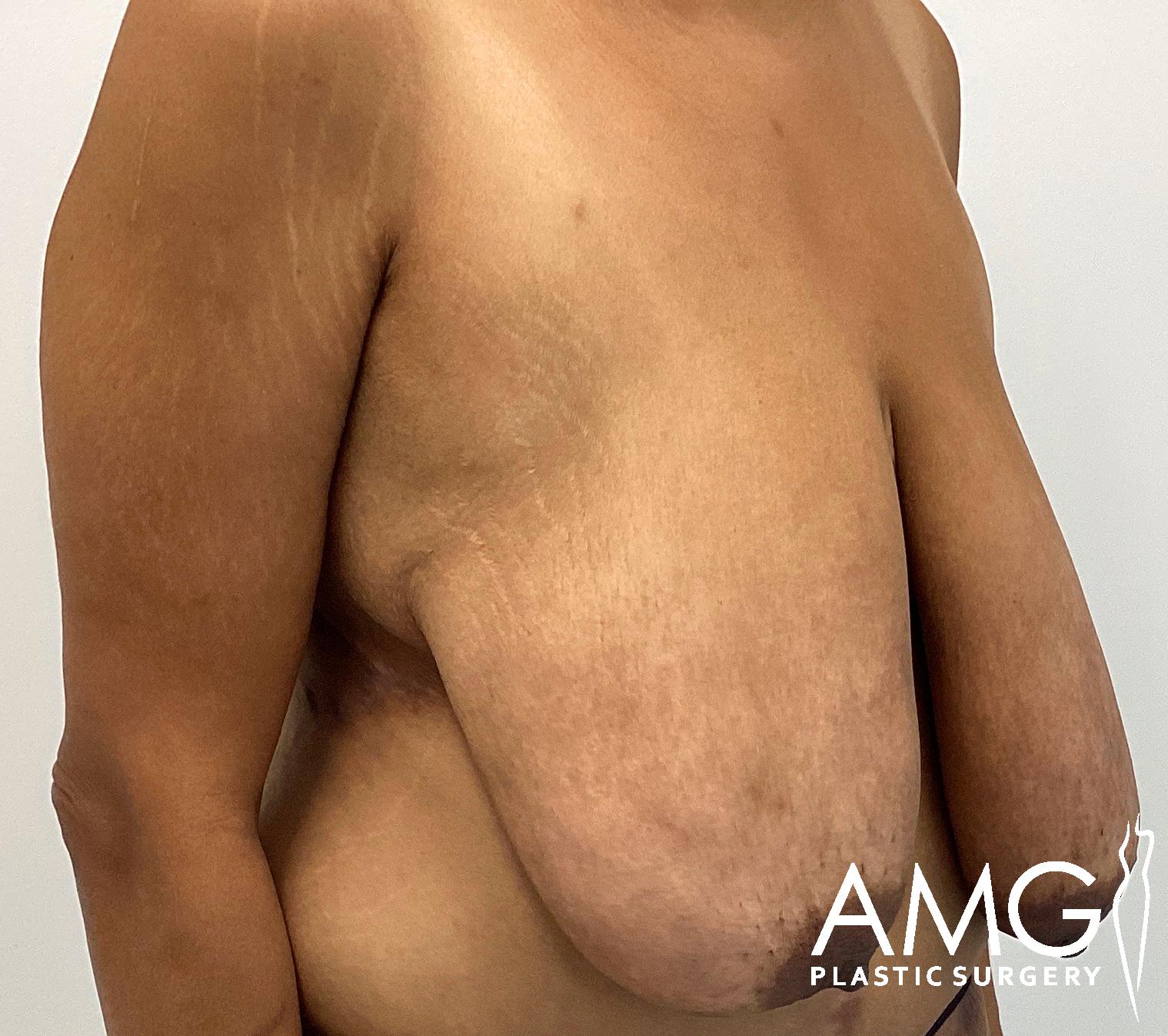 Side view of a person's bare chest and abdomen, with logo "AMG Plastic Surgery" in the lower right corner. The skin appears slightly stretched and contoured naturally.
