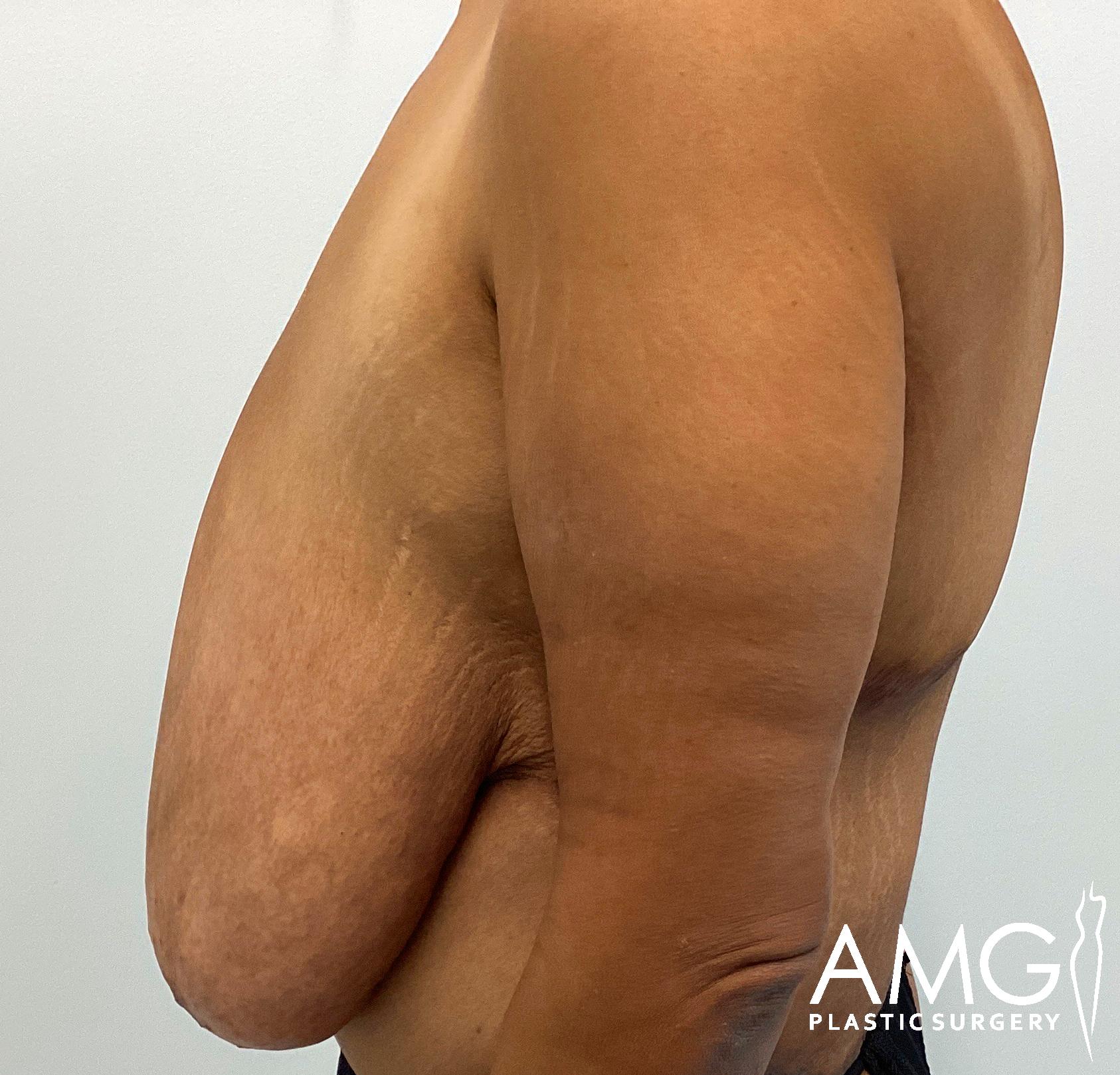 Side view of a person's torso and arm, showing excess skin on the upper arm. The image has a logo at the bottom right corner.