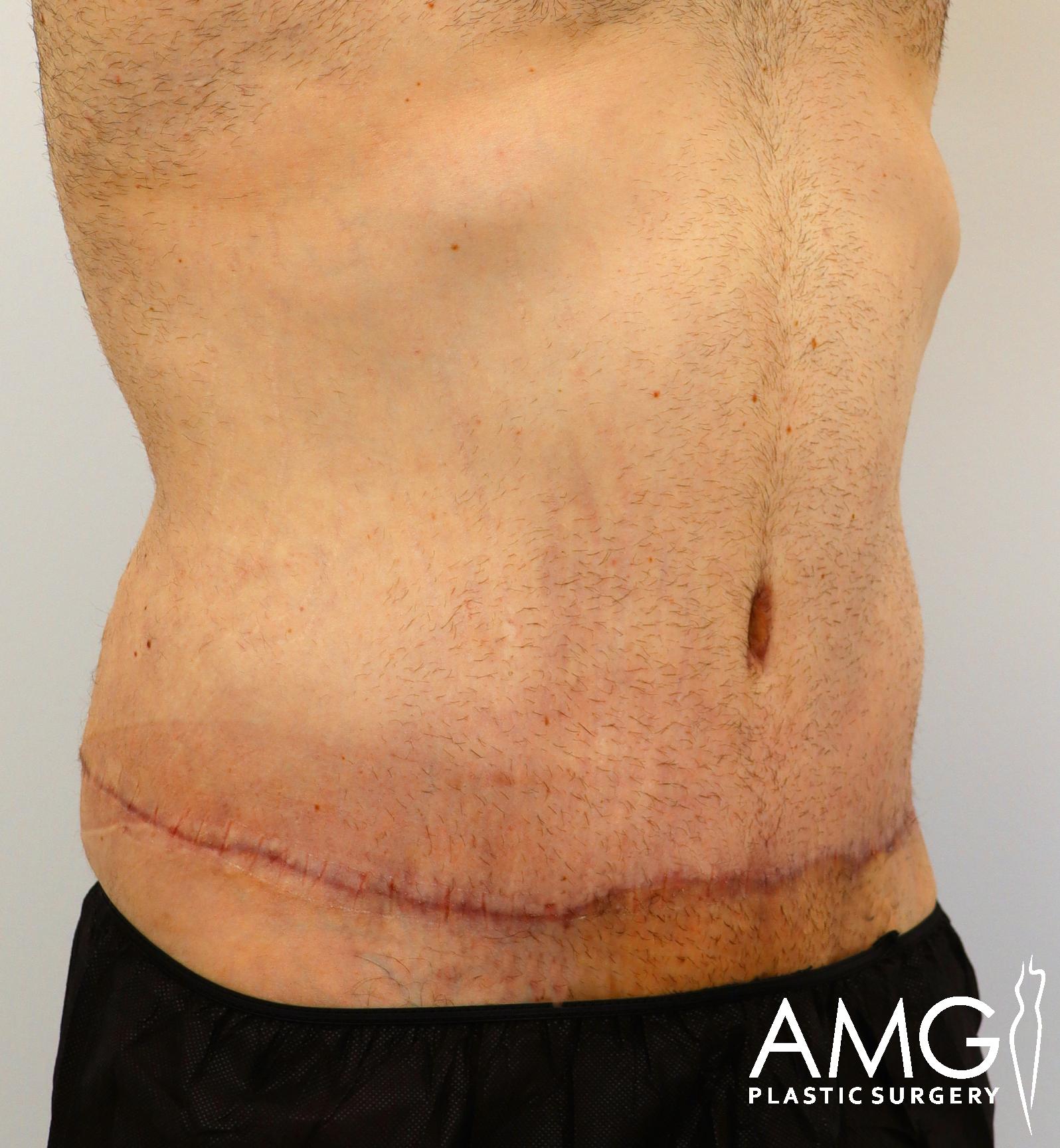 Close-up of a person's torso with a healing surgical scar across the lower abdomen. The person is wearing black shorts. Logo of AMG Plastic Surgery is visible in the bottom right corner.