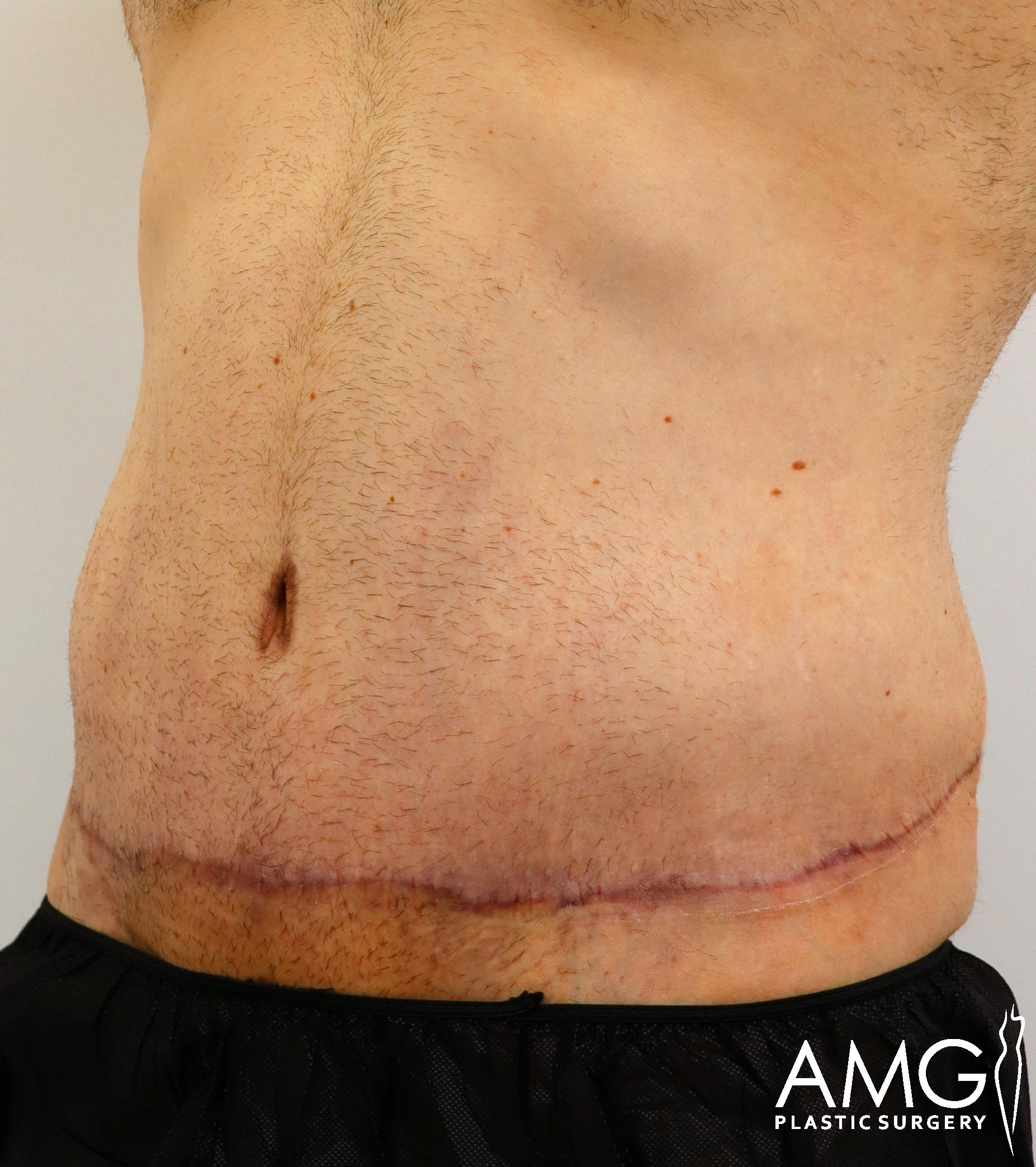 Close-up of a person's abdominal area showing a horizontal surgical scar. The skin appears healed, with some redness along the scar line. The person is wearing dark clothing at the waist.