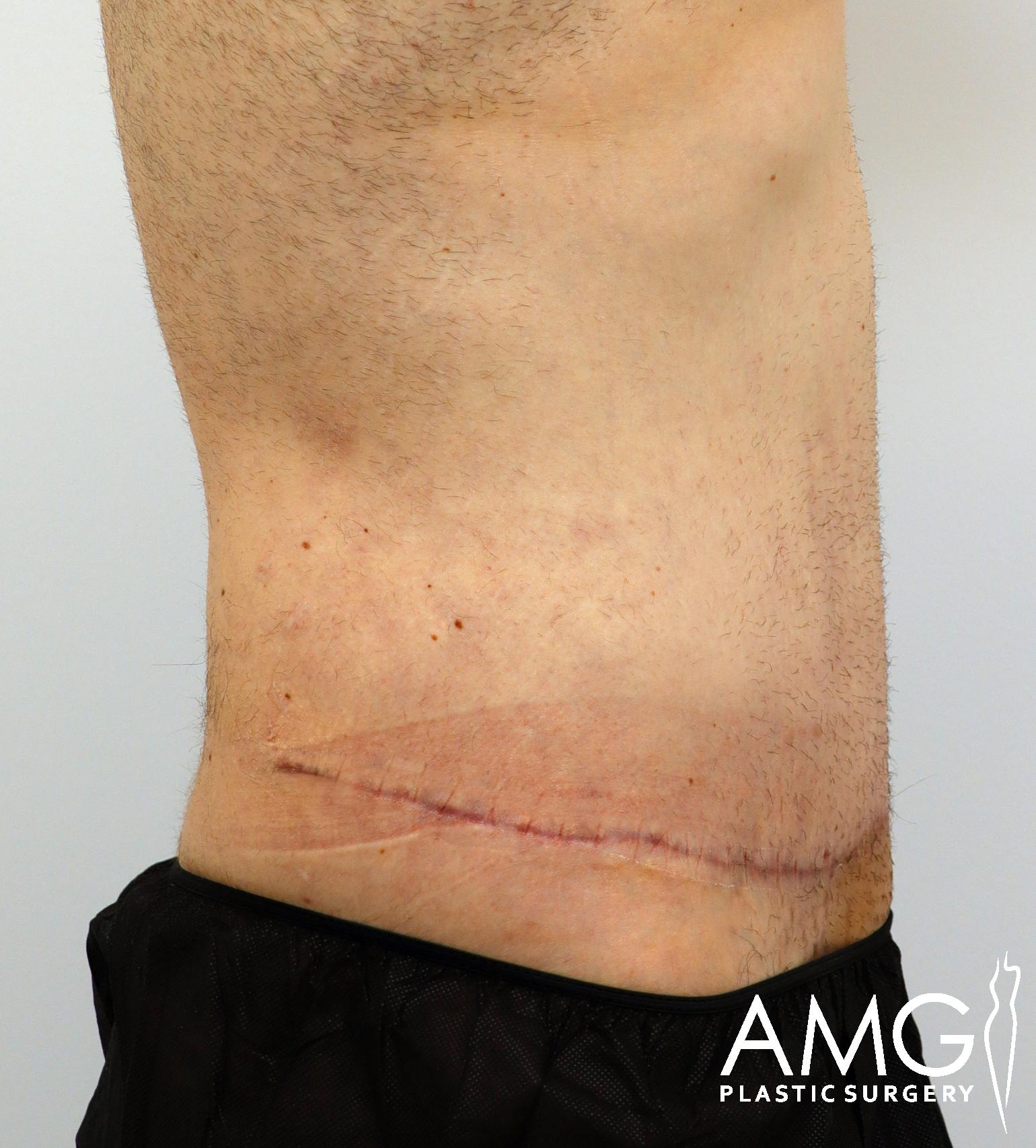 A close-up of a lower back showing a large, healing surgical scar. The person is wearing black clothing. The image has the logo "AMG Plastic Surgery" in the corner.