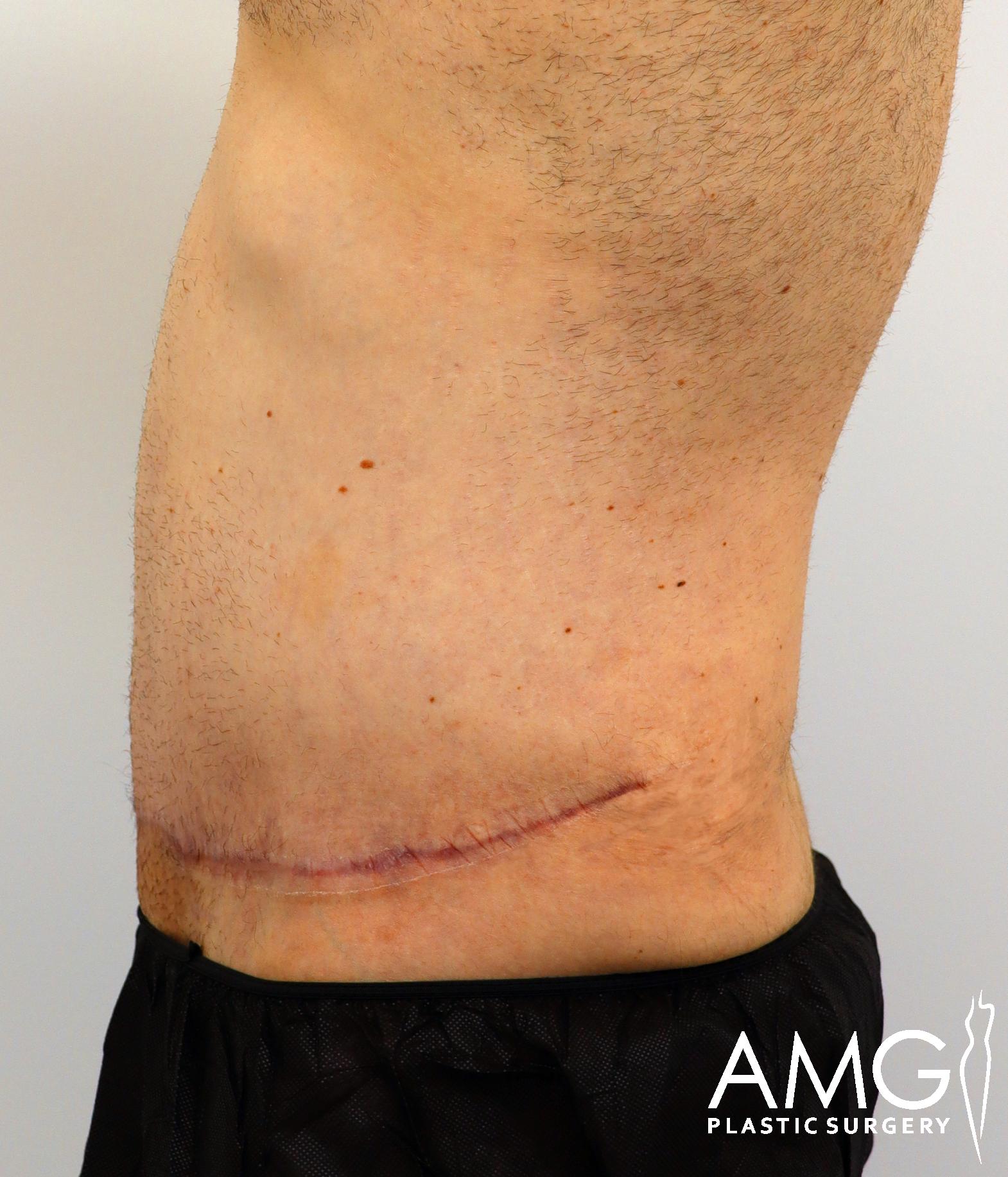 Side view of a person’s torso showing a healing surgical scar near the lower abdomen, with some visible body hair and mole. The individual is wearing dark pants.