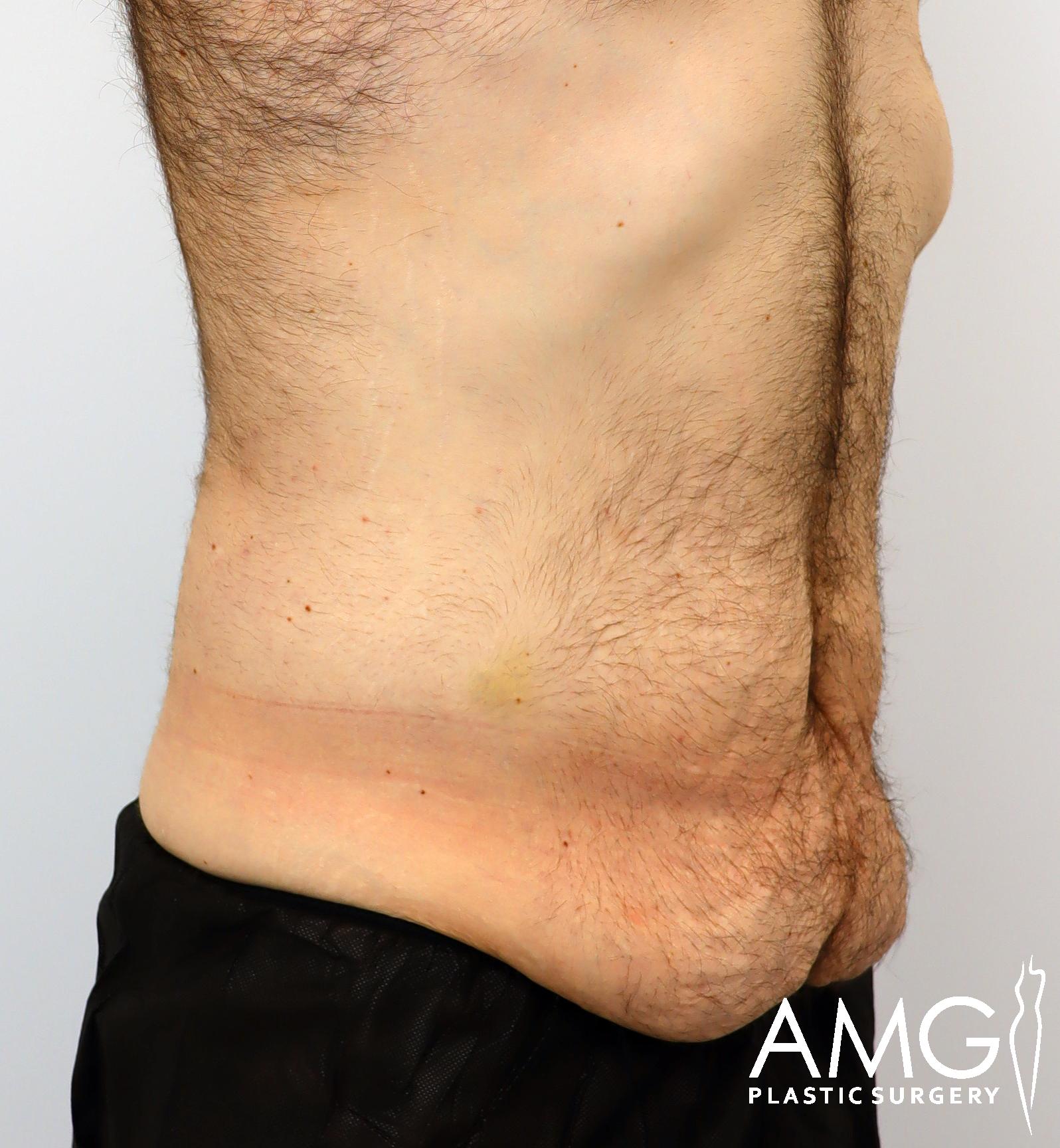 Side view of a person's abdomen and waist with loose skin, displaying signs of possible weight loss or surgery.