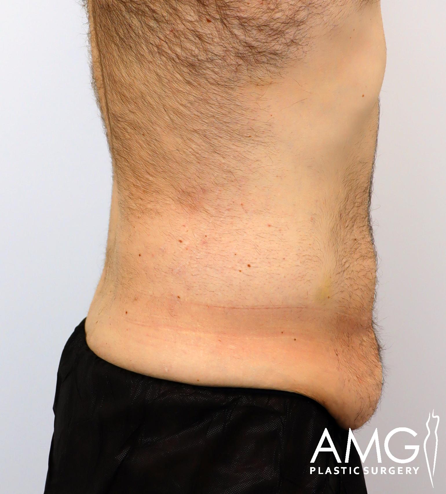 Side view of a person's bare torso and abdomen with excess skin folds, wearing dark shorts. The image includes a logo for AMG Plastic Surgery.