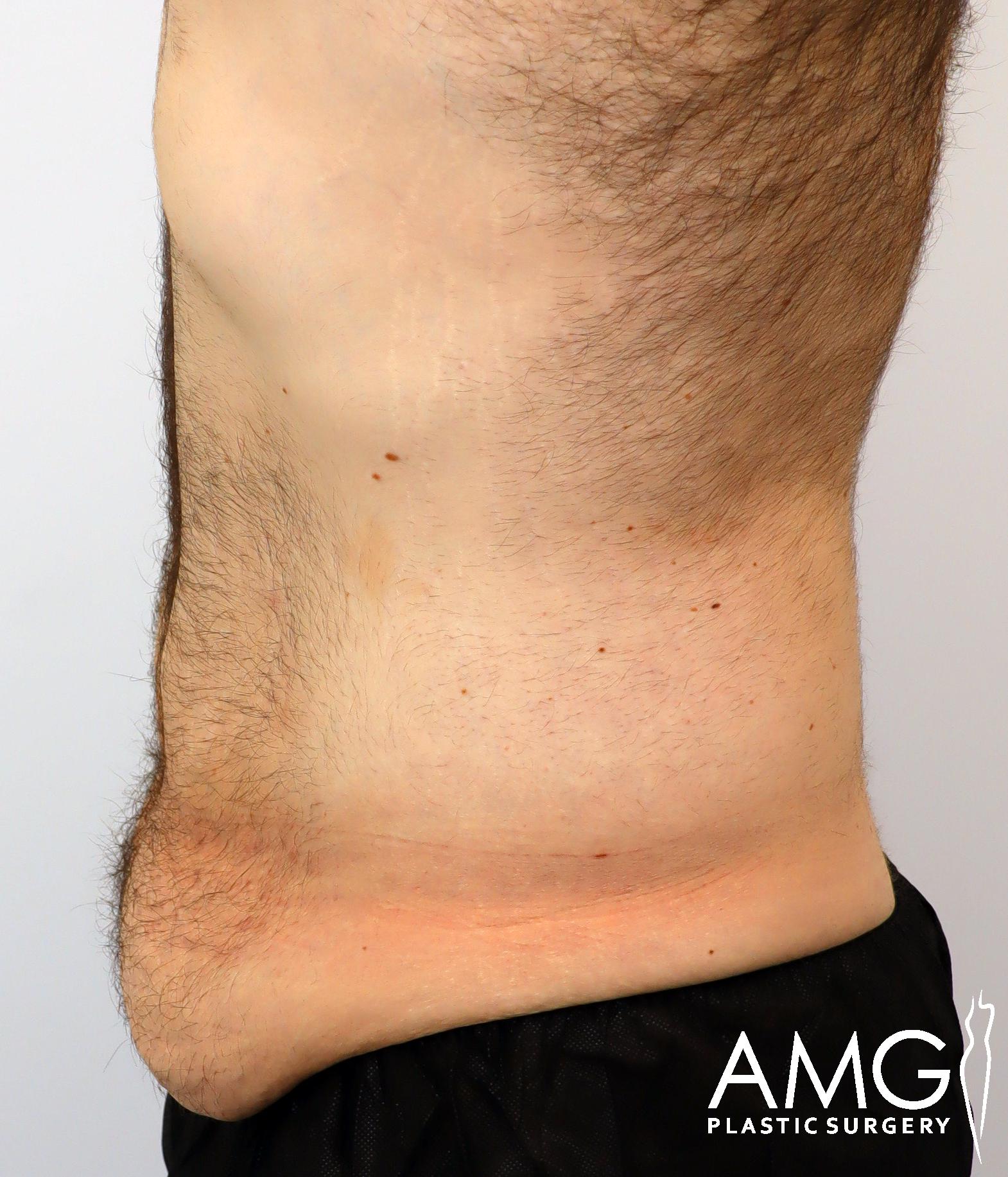 Side view of a person's lower back and abdomen showing loose skin above the waist. The skin appears saggy and folded. The image has a watermark of AMG Plastic Surgery in the bottom right corner.