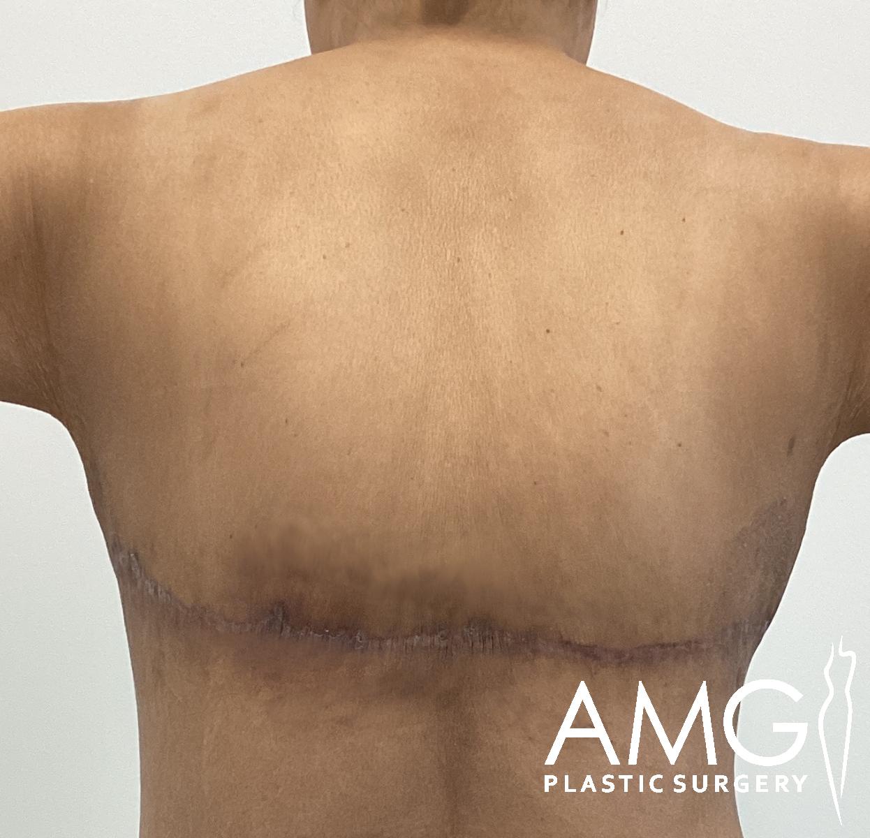 A person’s back showing a horizontal surgical scar across the lower back, arms slightly raised, with the logo AMG Plastic Surgery in the bottom right corner.