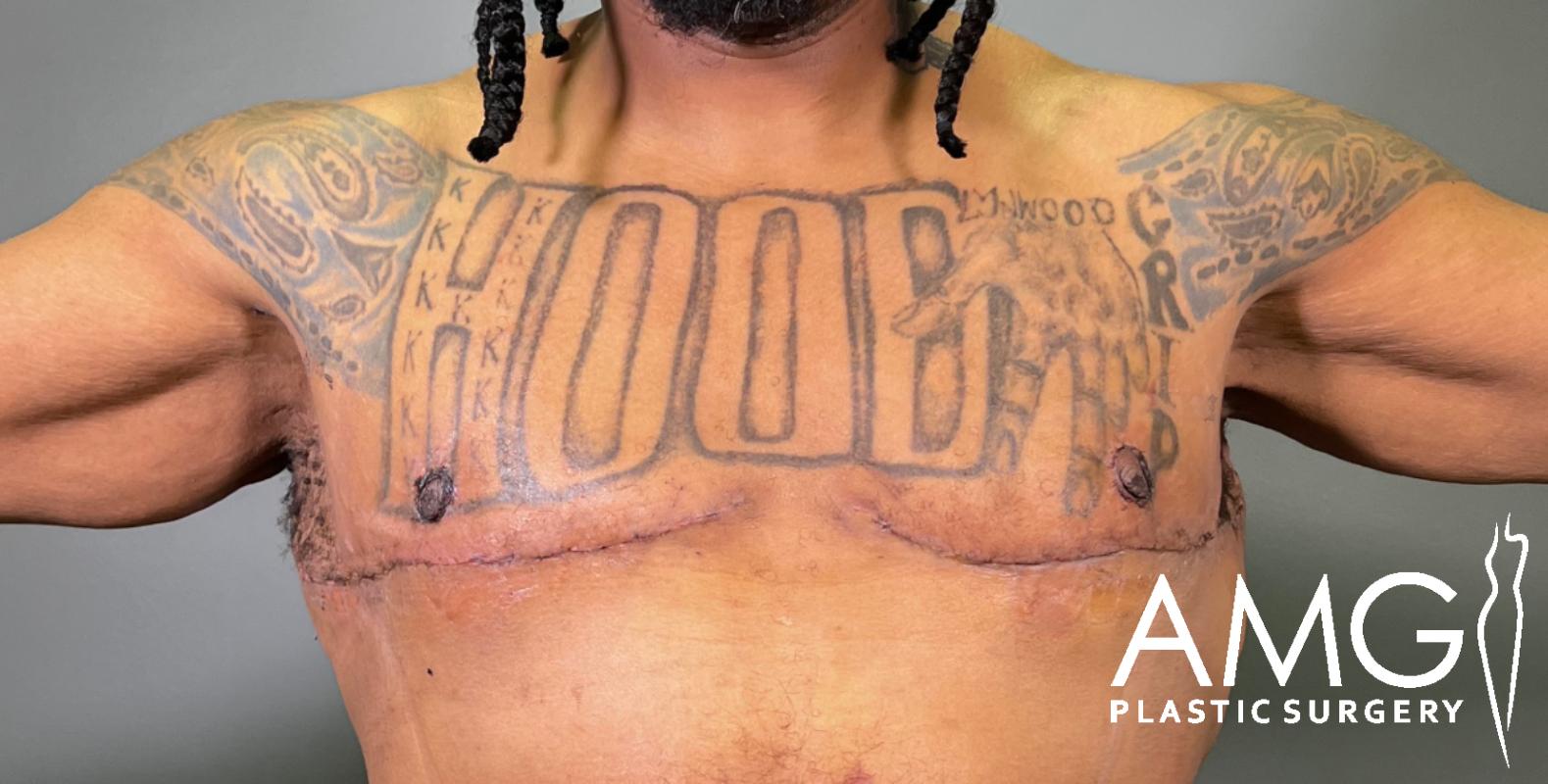 A person with tattoos on their chest and arms shows healing scars below the chest, likely from top surgery. The logo AMG Plastic Surgery is visible in the lower right corner.