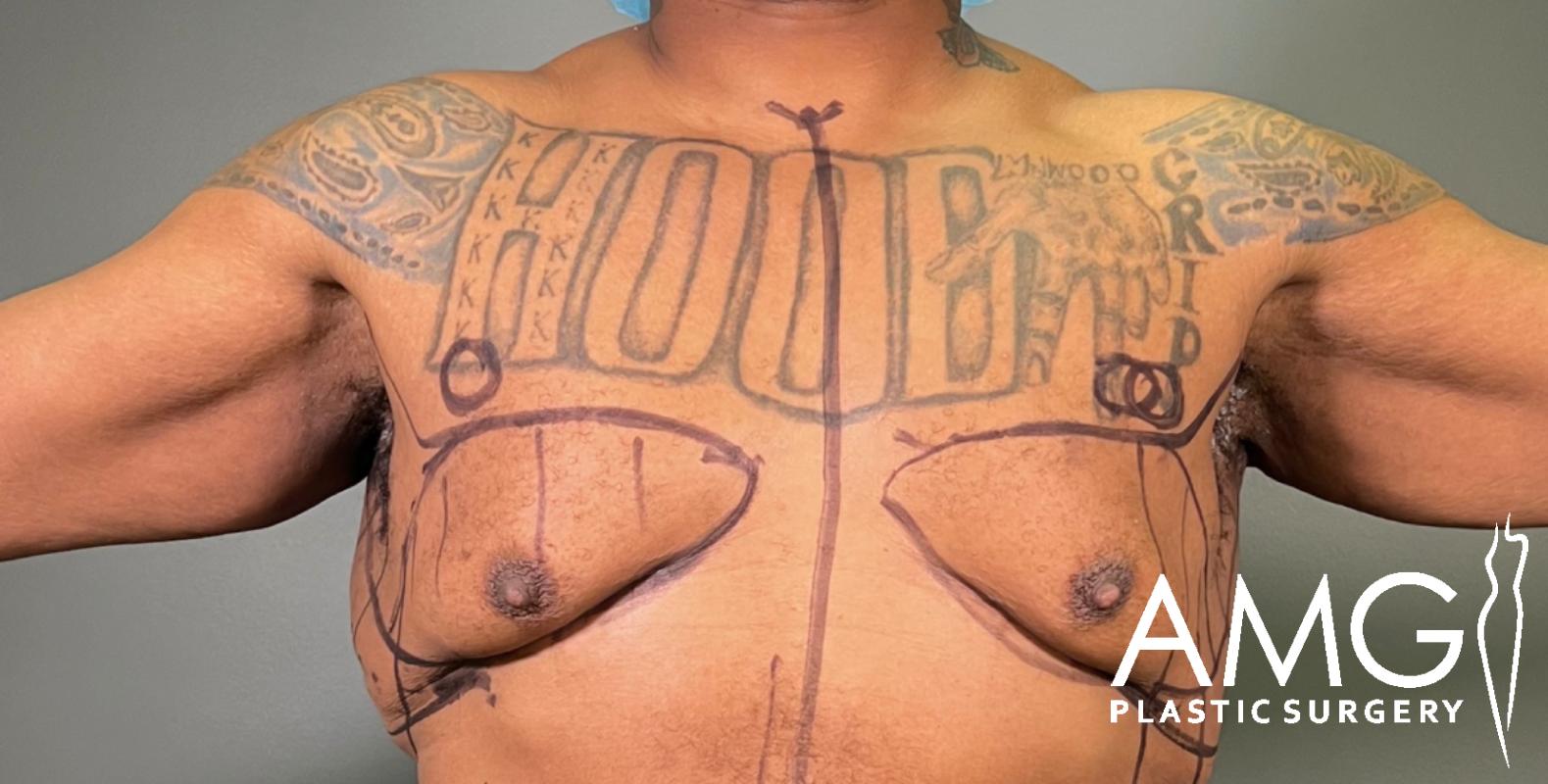 A person with chest tattoos stands with arms out. Surgical markings are drawn on the chest, indicating planned plastic surgery. The AMG Plastic Surgery logo appears in the lower right corner.