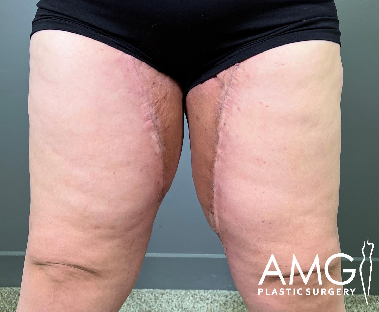 A person standing with visible vertical scars on both inner thighs, likely from surgery. They are wearing black shorts. The bottom right corner features the AMG Plastic Surgery logo.
