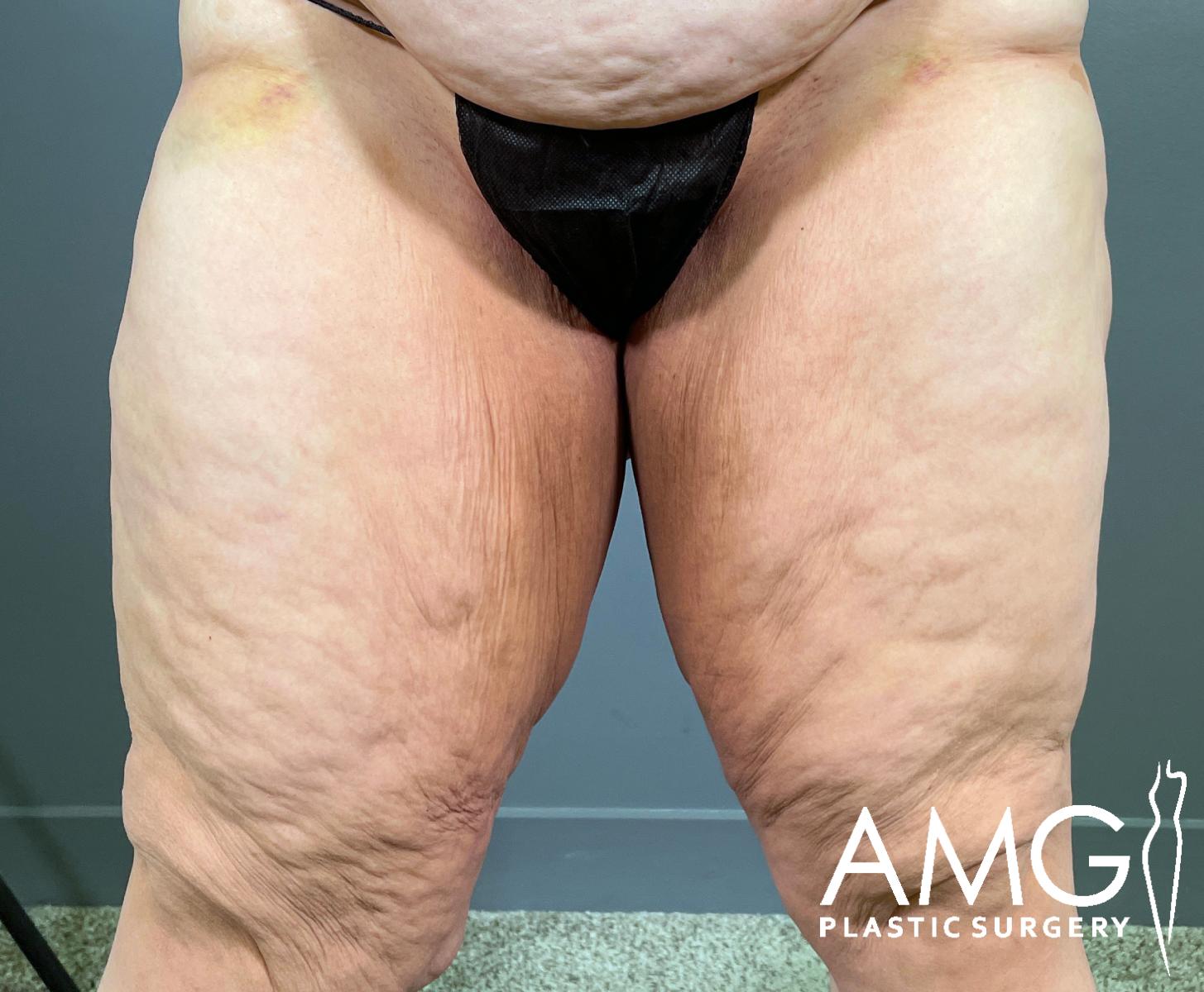 A close-up of a persons upper thighs showing loose, wrinkled skin and cellulite. The person is standing, wearing black underwear. The AMG Plastic Surgery logo is visible in the corner.