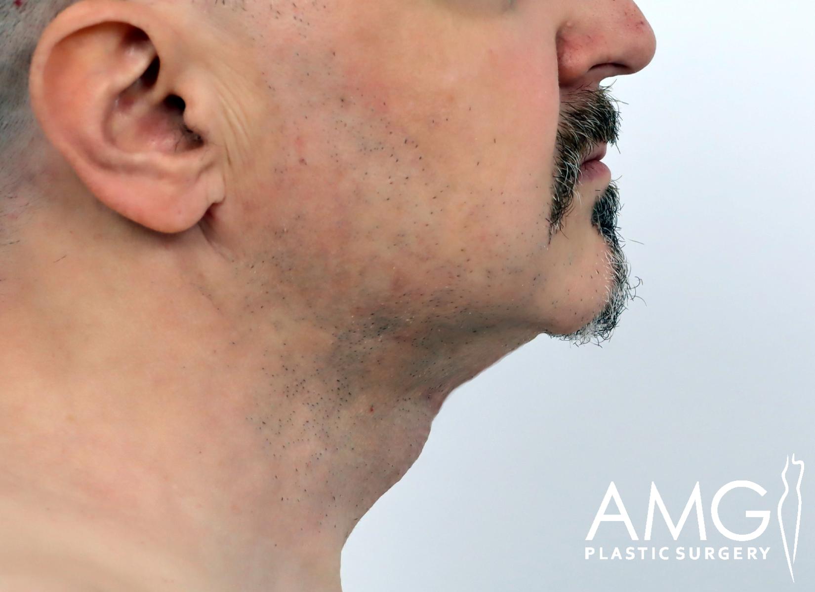 Side profile of a middle-aged mans face and neck with visible stubble and slight sagging under the chin. The image has the AMG Plastic Surgery logo in the lower right corner.