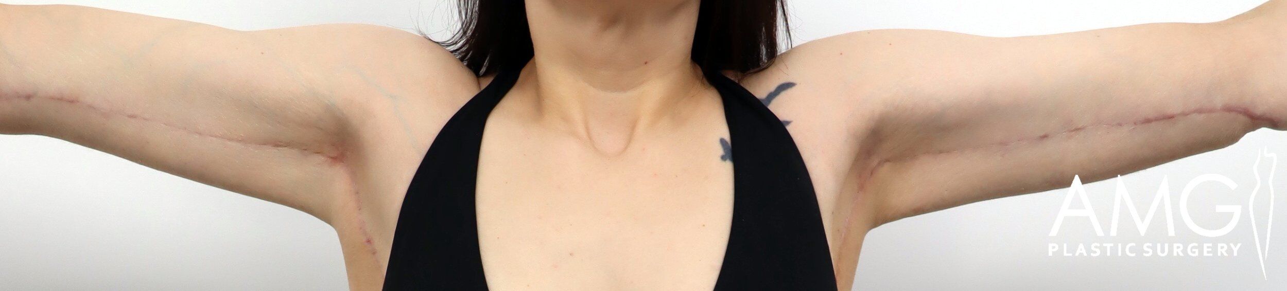 Front view of a patient’s upper arms after arm lift surgery, showing improved contour, reduced excess skin, and more defined arm shape with arms raised, AMG Plastic Surgery.