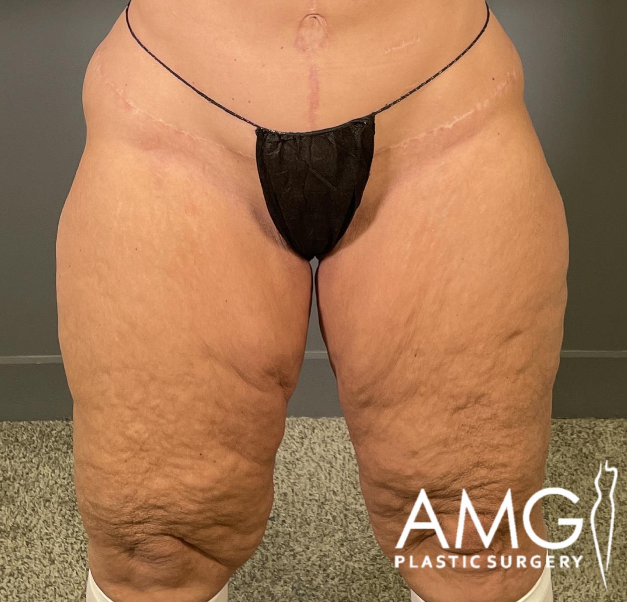 Front view of a woman's thighs before thigh contouring showing excess skin and tissue on the upper legs, AMG Plastic Surgery.