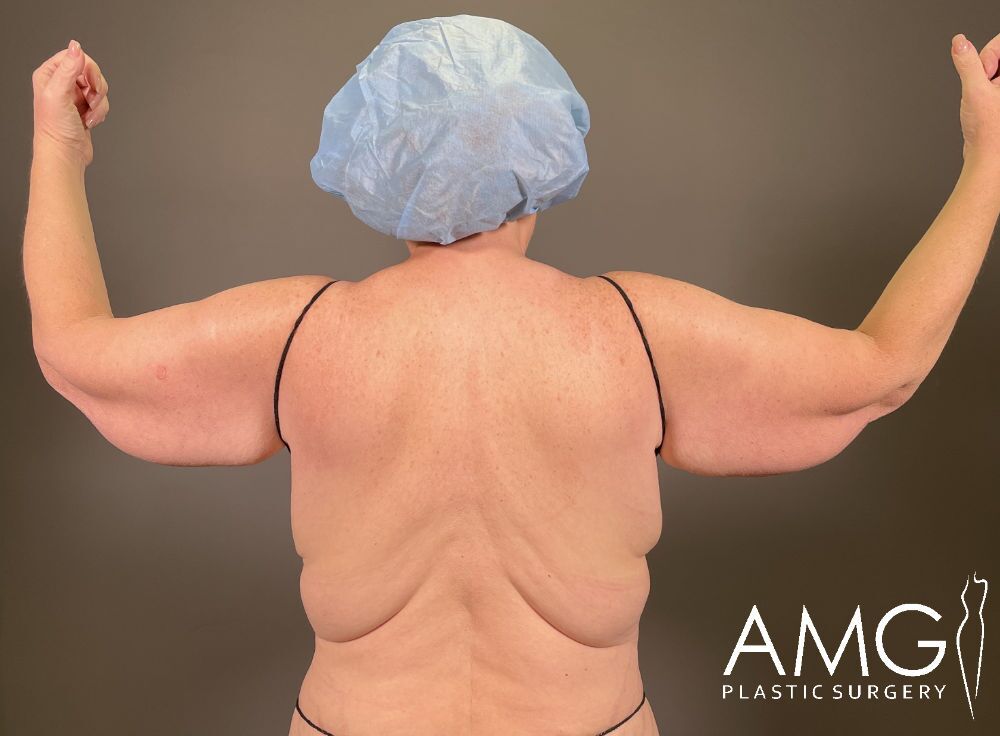 A person’s back showing a horizontal surgical scar across the lower back, arms slightly raised, with the logo AMG Plastic Surgery in the bottom right corner.