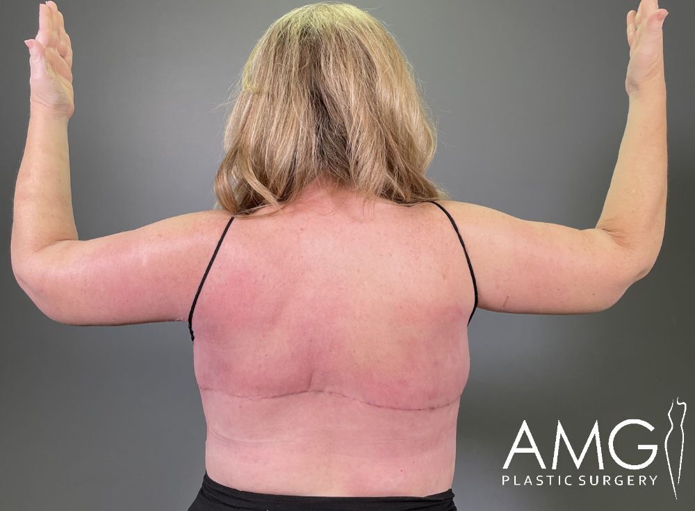 A person’s back showing a horizontal surgical scar across the lower back, arms slightly raised, with the logo AMG Plastic Surgery in the bottom right corner.