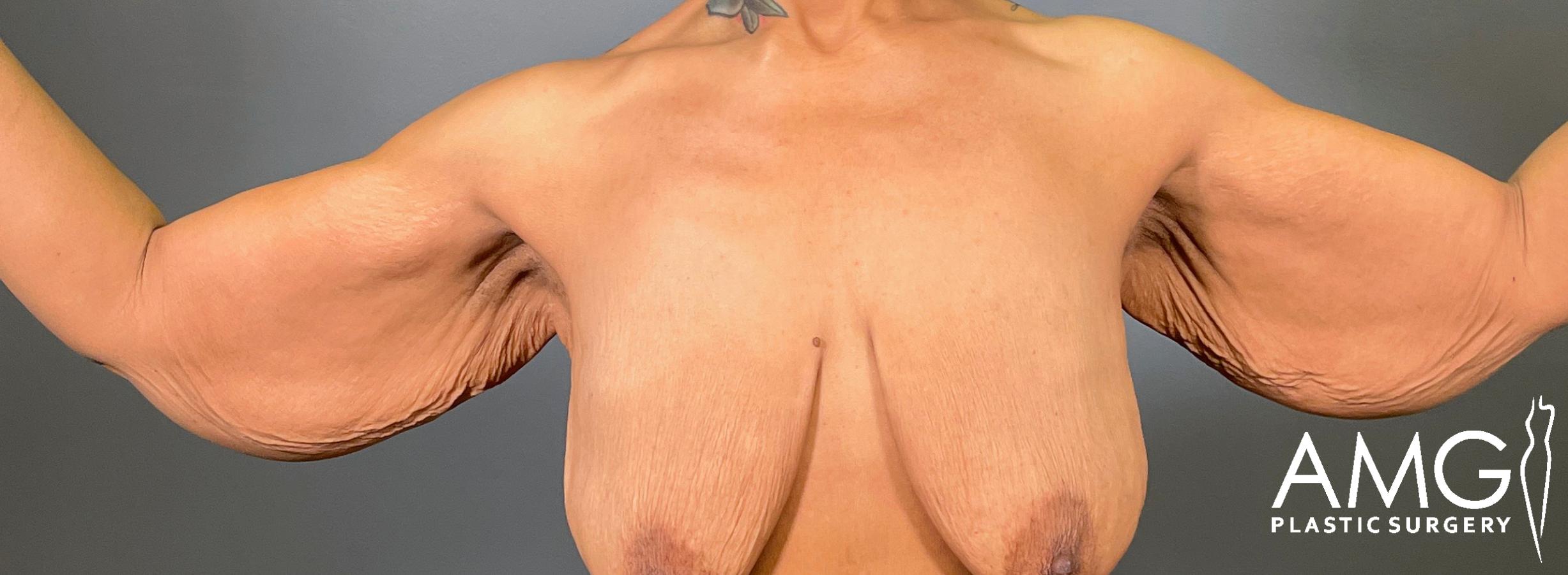 Arm Lift before surgery – front view, AMG Plastic Surgery