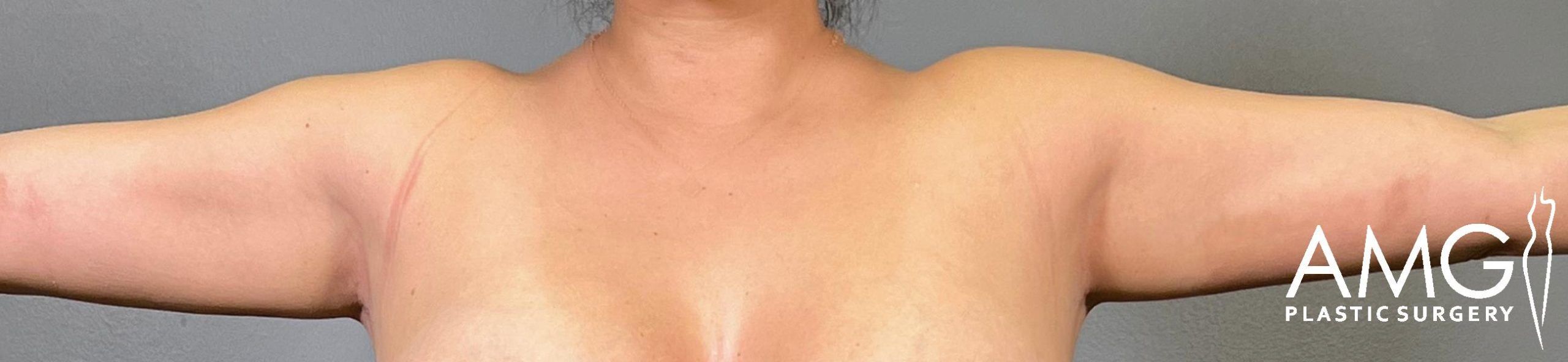 Arm Liposuction after surgery – front view, AMG Plastic Surgery
