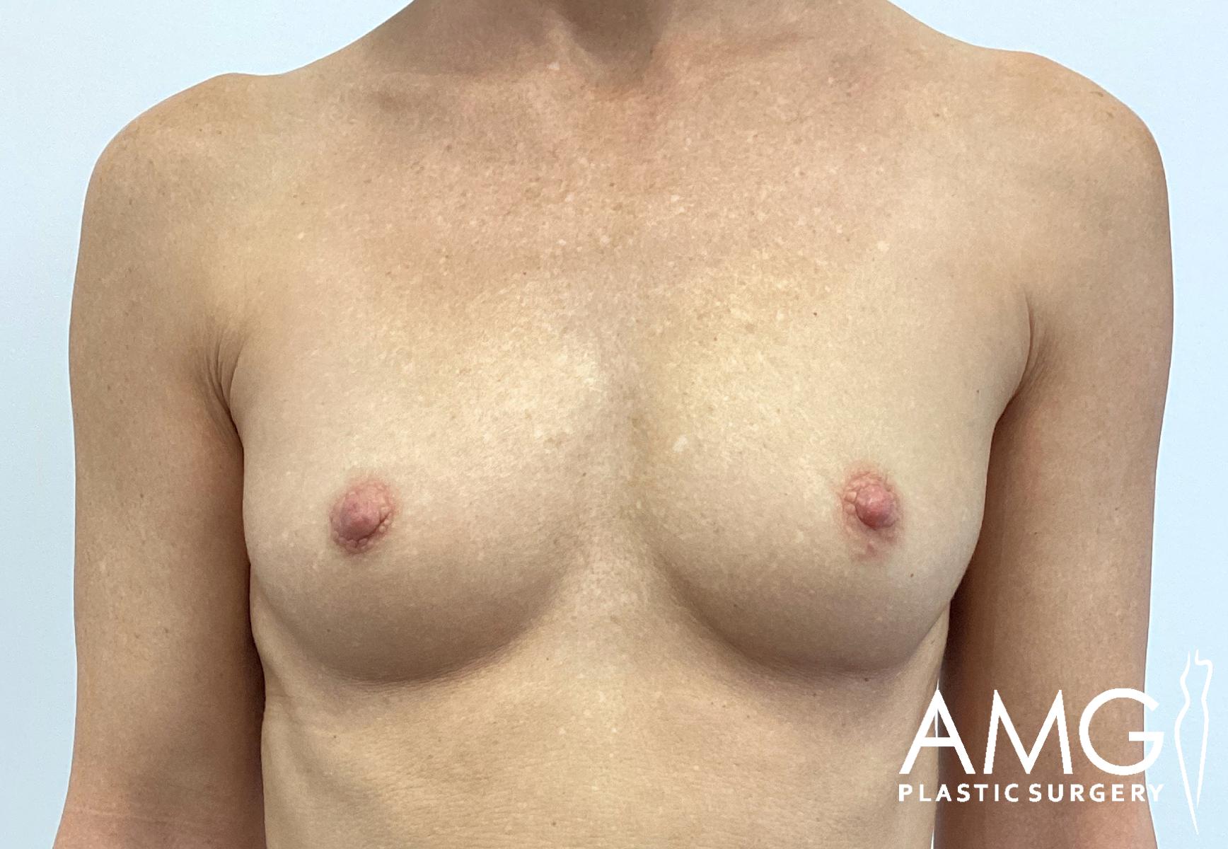 Breast Augmentation before surgery – front view, AMG Plastic Surgery