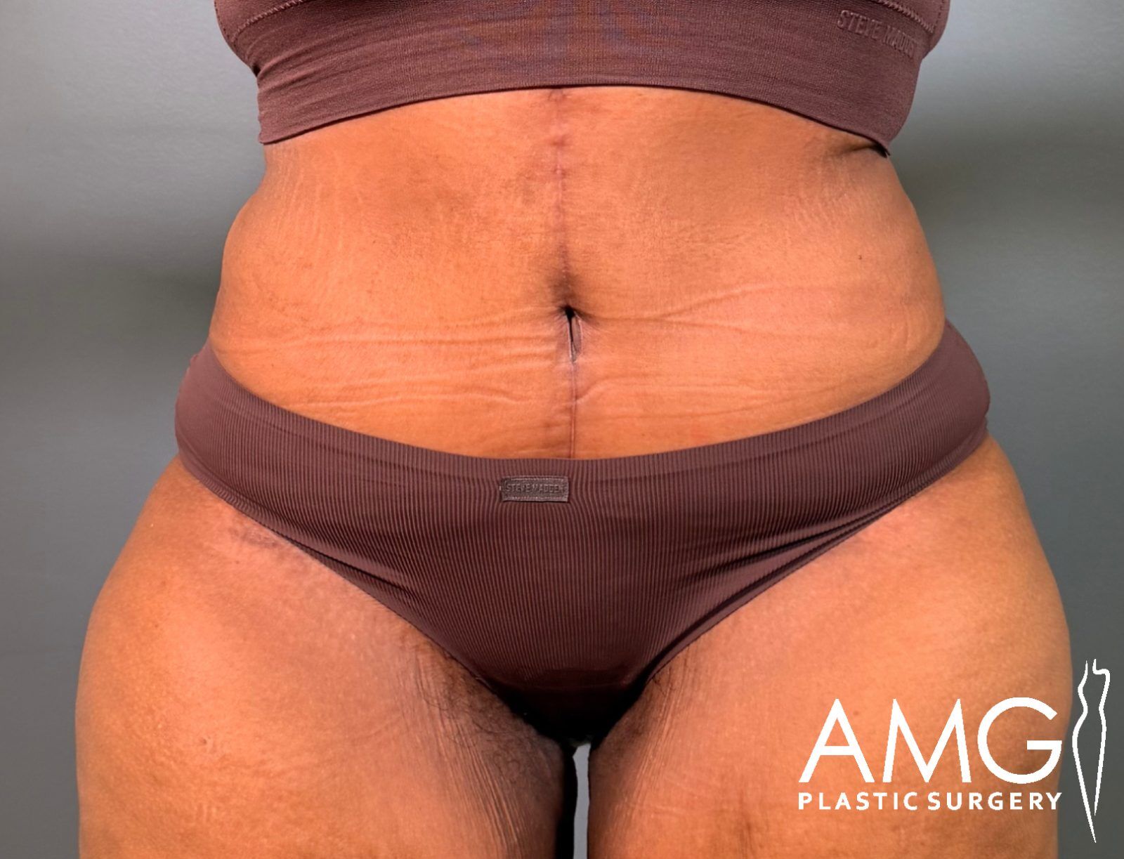 Front view of a woman's abdomen after fleur-de-lis tummy tuck showing a flatter, more contoured abdomen with a visible vertical scar, AMG Plastic Surgery.
