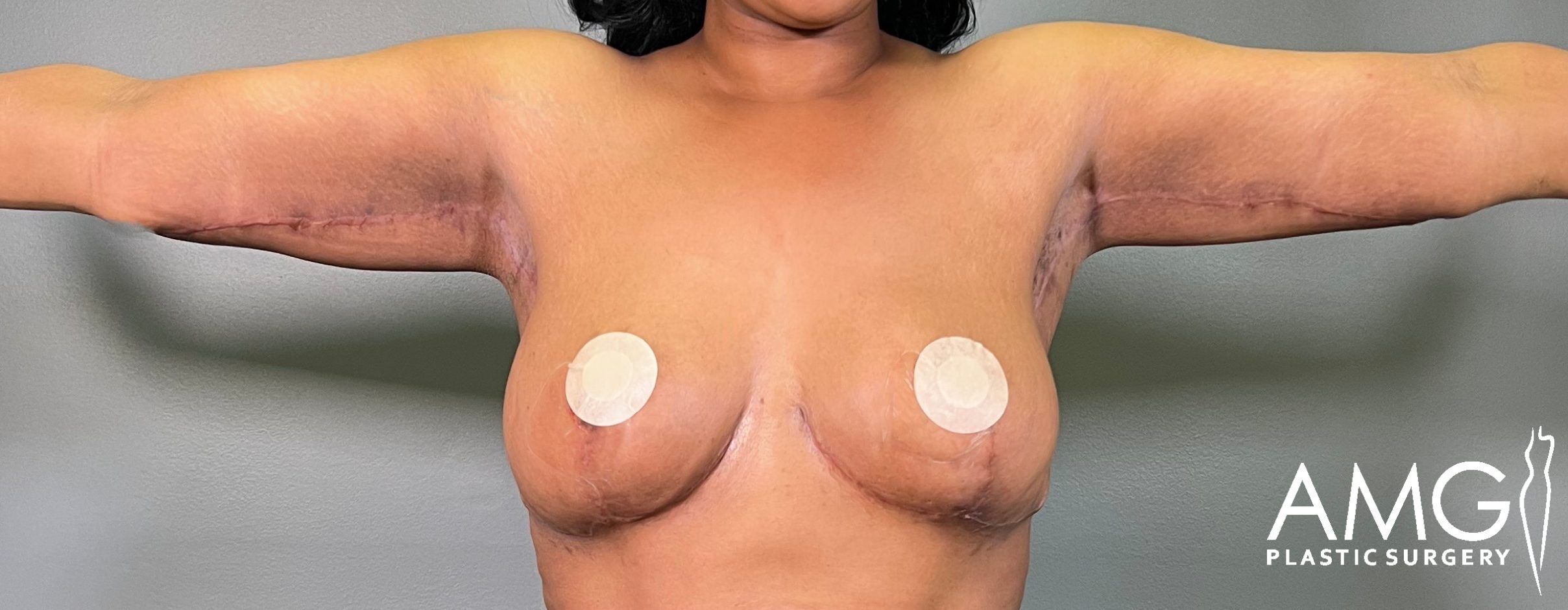 Upper Body Lift after surgery – front view, AMG Plastic Surgery