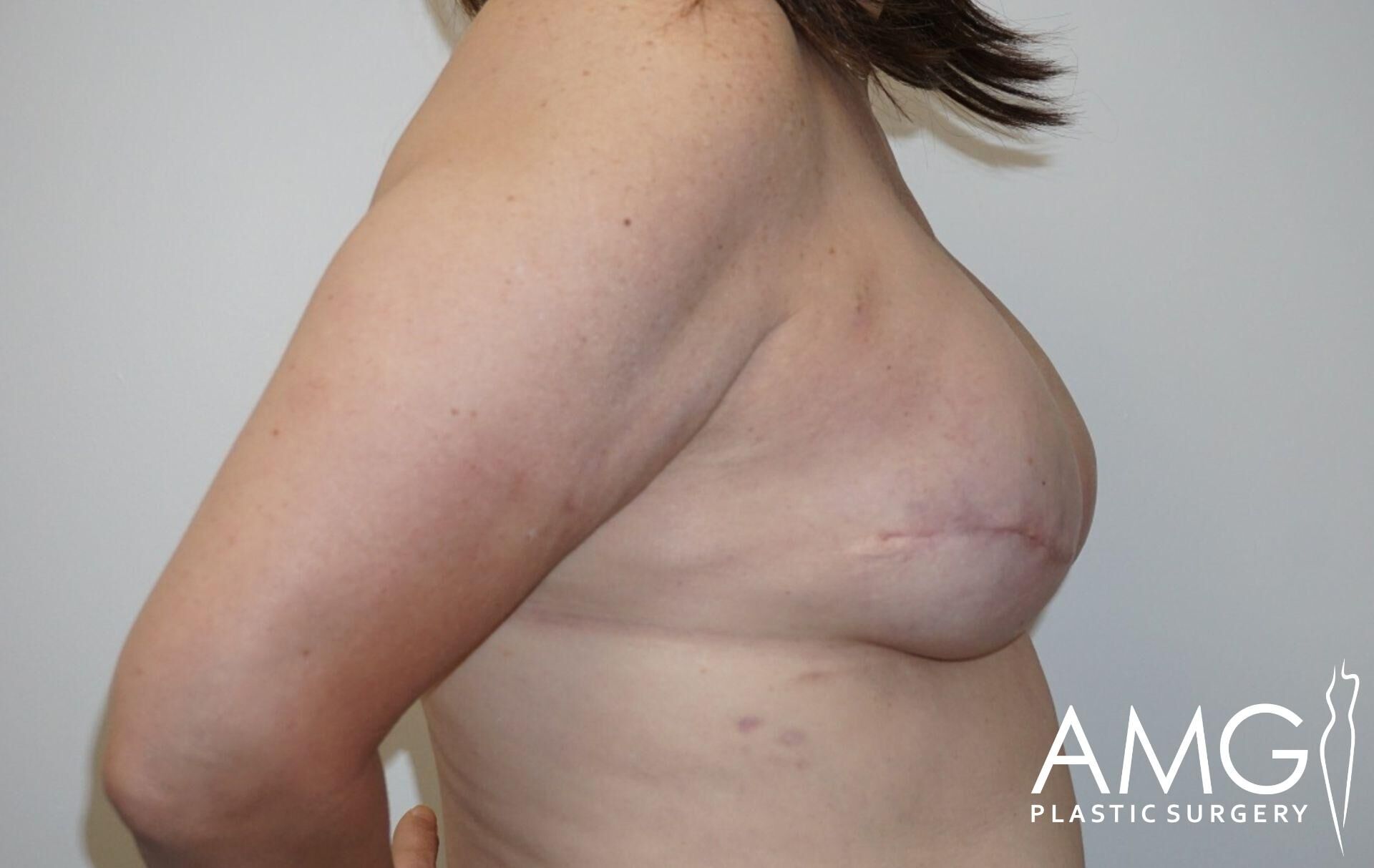 A side view of a person's upper body with a surgical scar on the breast area. The image has the logo "AMG Plastic Surgery" at the bottom right.