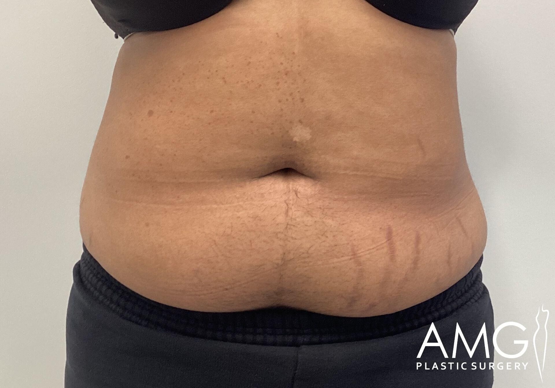 Close-up of a person's bare midsection showing stretch marks and skin folds, with the logo "AMG Plastic Surgery" in the corner.