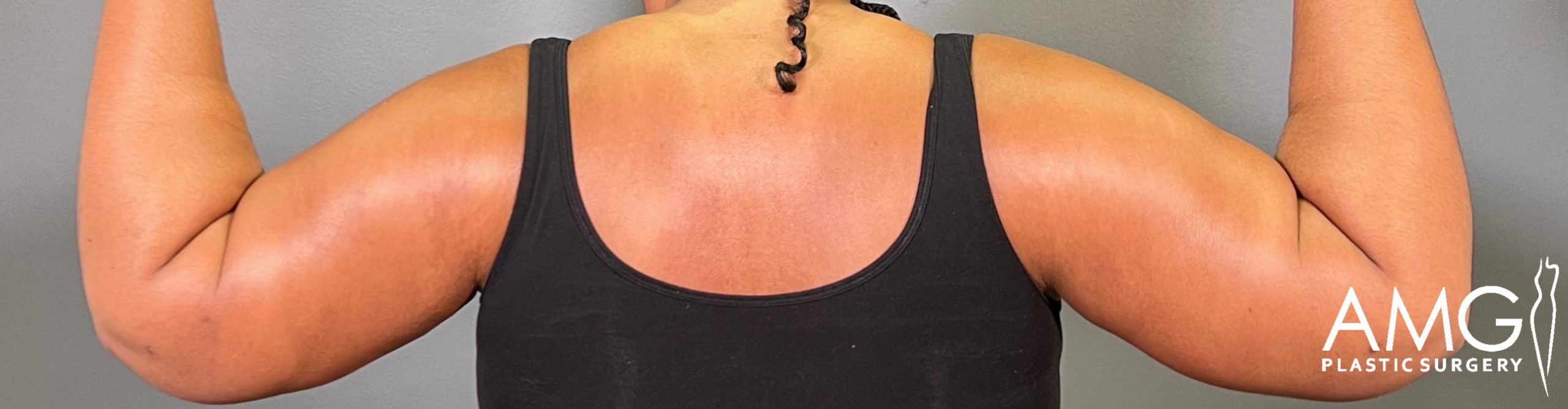 Rear view after brachioplasty, arms elevated, demonstrating smoother contours and improved firmness of the upper arms, AMG Plastic Surgery.