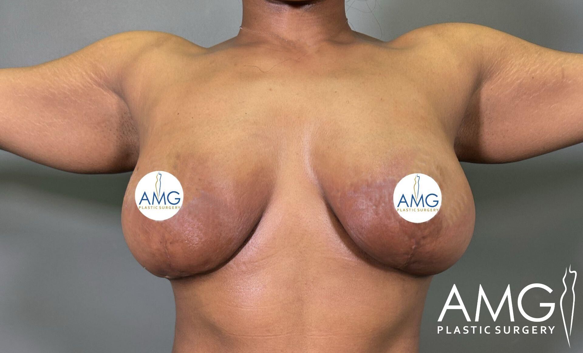 Person showing post-surgical scarring on the chest and arms, with AMG Plastic Surgery logos covering the nipples.