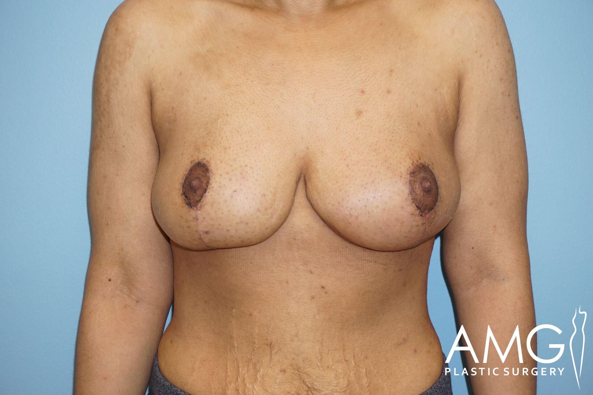 Person with visible breast surgery scars and an AMG Plastic Surgery watermark in the lower right corner.
